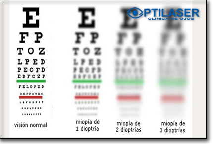 Clinica de ojos Optilaser - Miopia